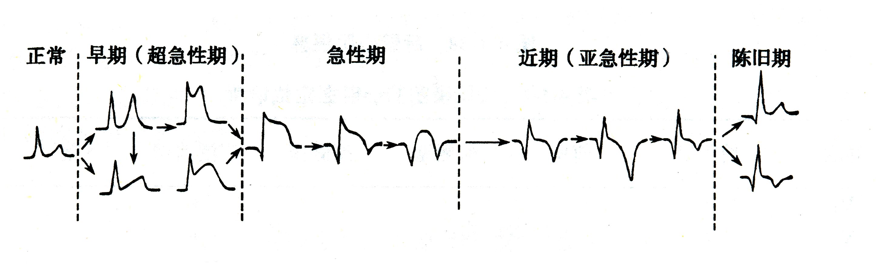 心肌梗死心电图变化